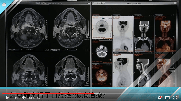 台中榮總 衛教影片 （口腔癌治療簡介）